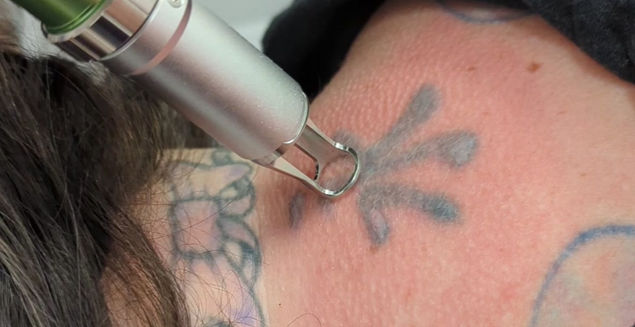 Laser Tattoo Removal
